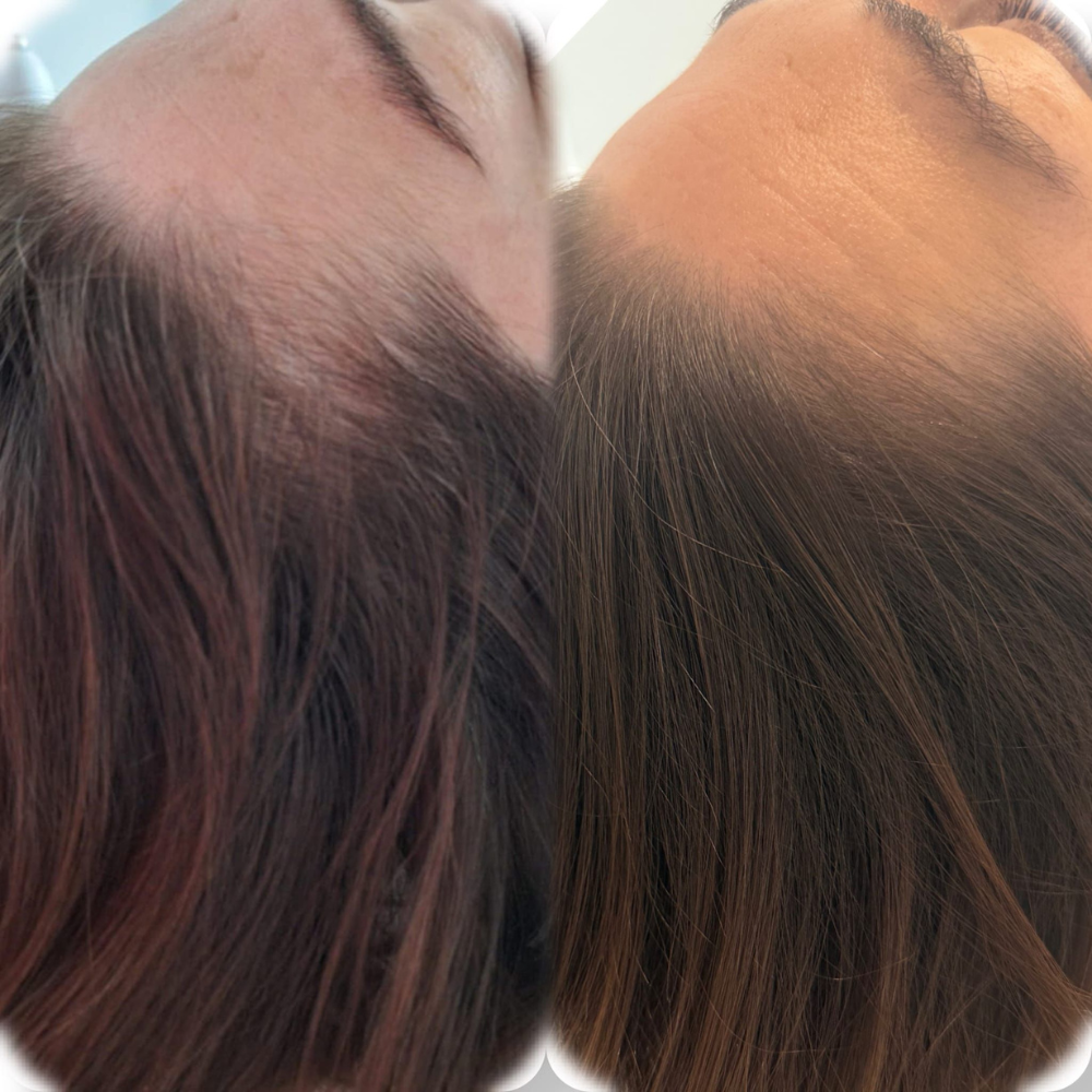 mehr haare dermation