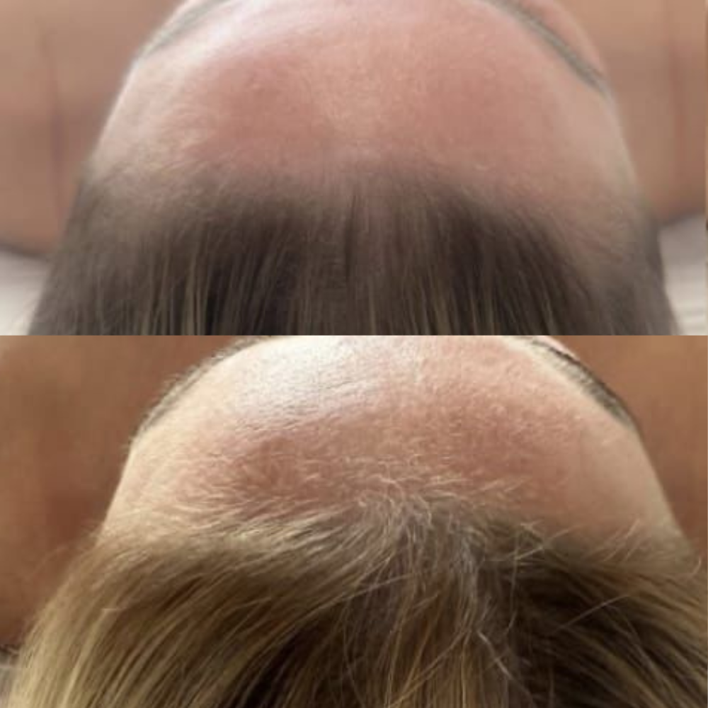 mehr haare dermation